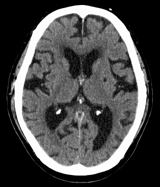 頭部新CT画像