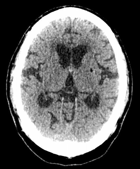 頭部旧CT画像